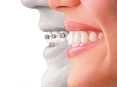 The image shows a side-by-side comparison of an adult s teeth with a child s teeth, likely for dental care or orthodontic purposes.