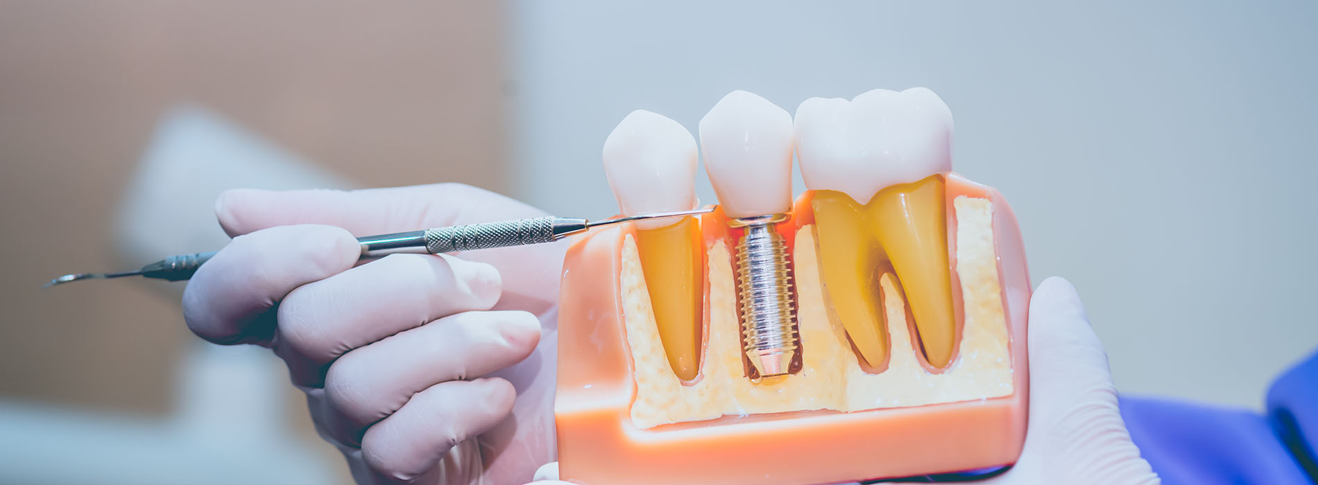 The image shows a close-up of a person s hands working on an object with multiple teeth-like structures, which appears to be some sort of dental device or appliance.
