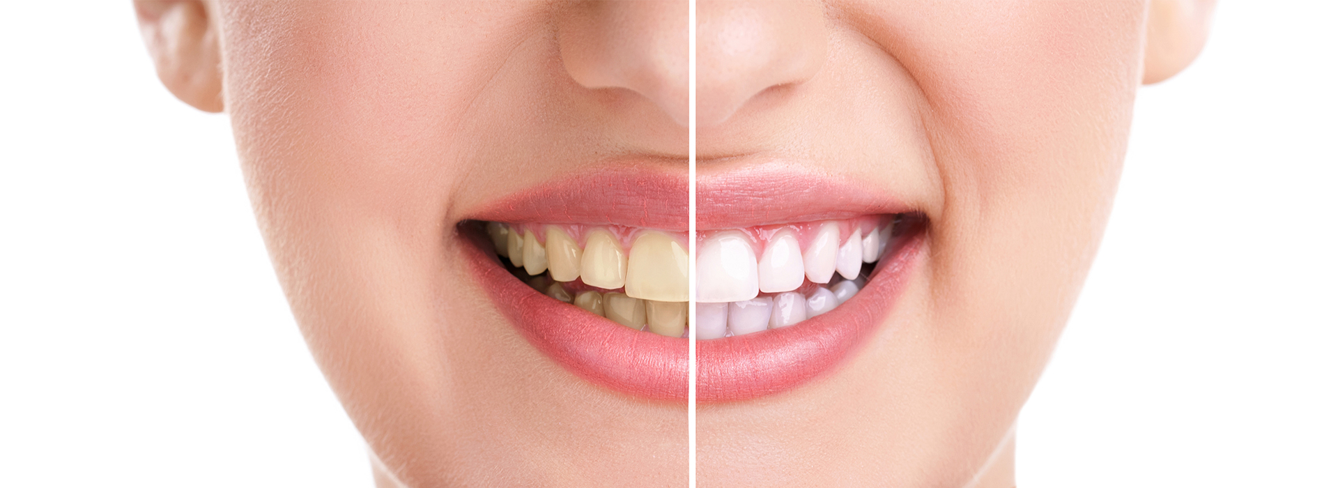 The image shows a close-up of a person s smiling face with teeth that are being enhanced by a cosmetic dental procedure, featuring a before and after comparison.