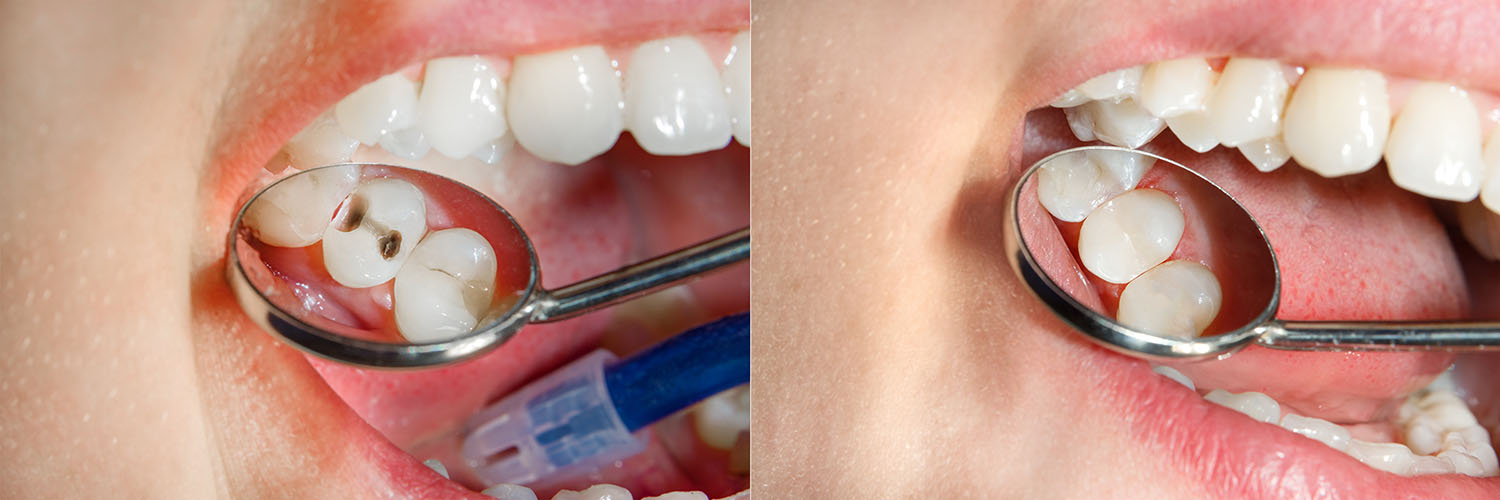 The image displays two photos side by side of a person s mouth showing a tooth with a dental mirror reflecting the interior of the mouth, highlighting the dental work being done.