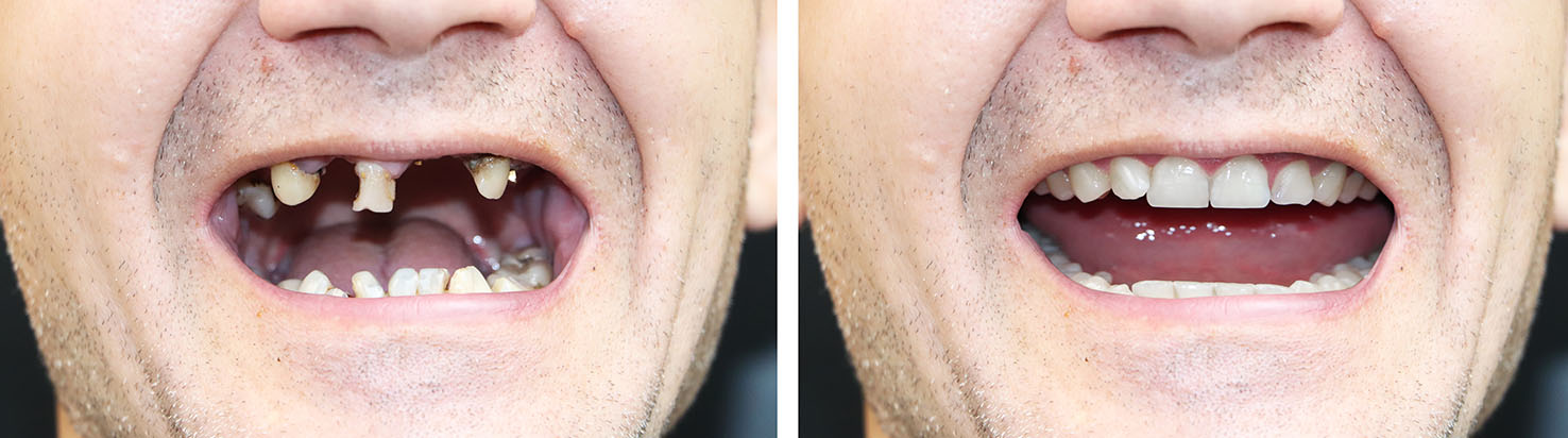 The image shows a person with multiple missing teeth smiling broadly, with two separate sections displaying different teeth conditions  the top section has no visible teeth, while the bottom section shows a full set of teeth.